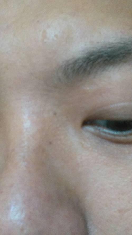 鼻子上的痣寓意探究