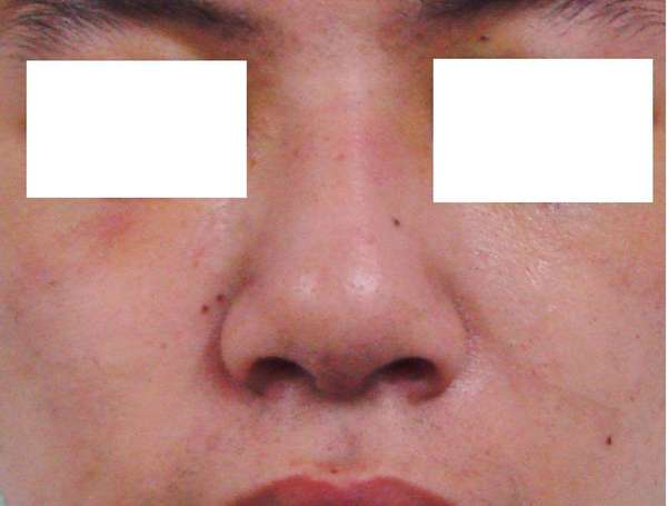 鼻子内壁溃烂的症状与图片解析