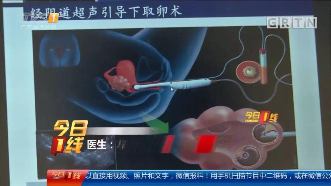 微刺激取卵方案哪家好，深度探讨与综合评估