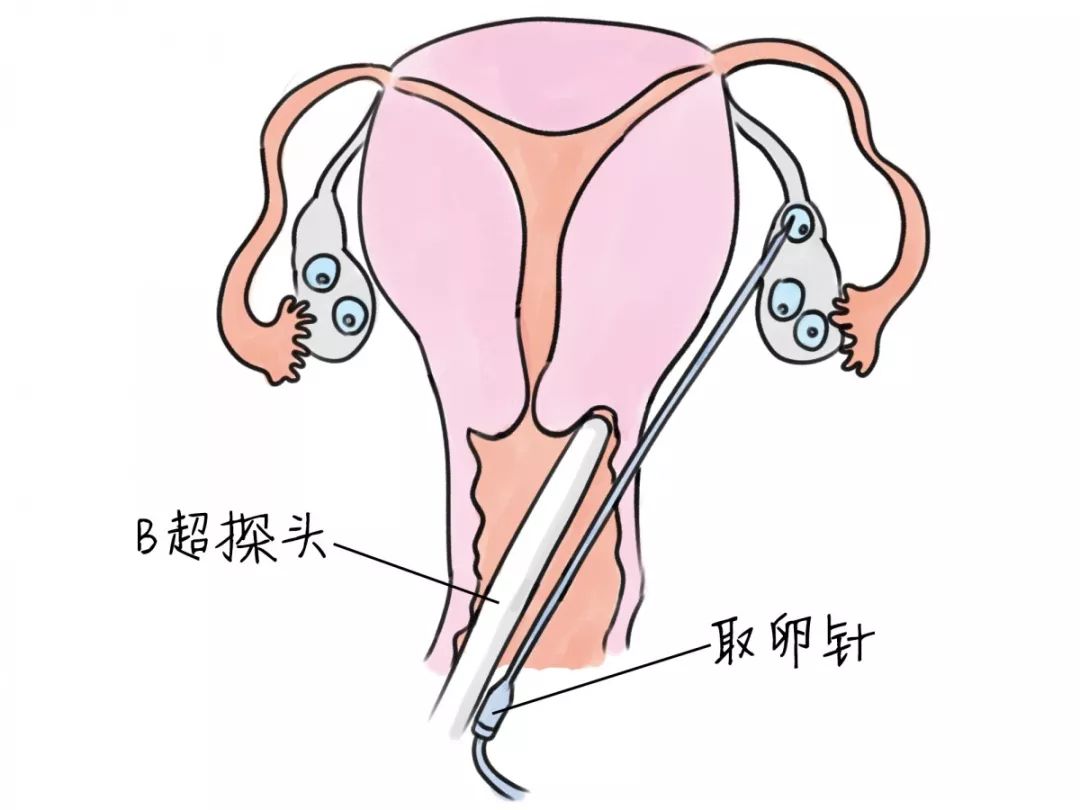 取卵后三天移植成功率及相关因素探讨