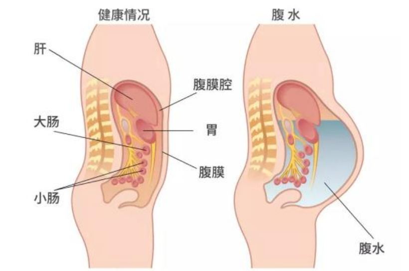 探讨没腹水取卵多可以移植吗这一问题