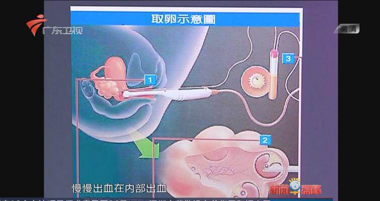 取卵过程中腹水的伤害及其影响，深入解析与应对策略