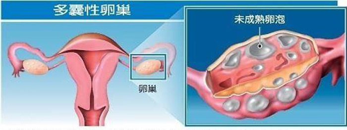 取卵后卵巢过度刺激，风险与应对策略